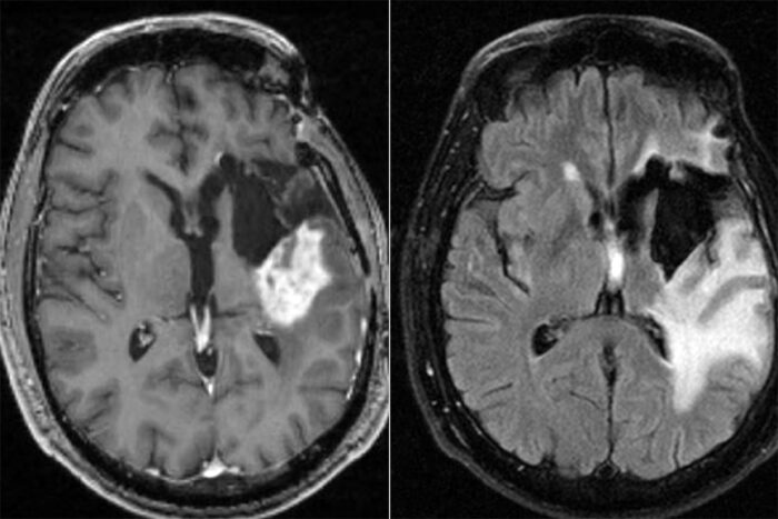 Brain scan of patient with glioblastoma